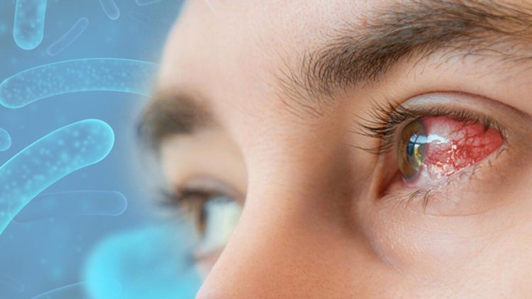 ABŞ-ı həyəcanlandıran bakteriya: Gözdə əriyir!  18 ştatda 81 nəfərdə müşahidə edilib, 4 nəfər ölüb